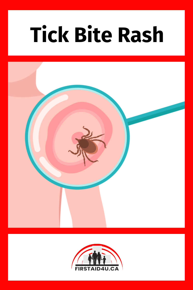 "Bullseye" Rash - Tick Bite